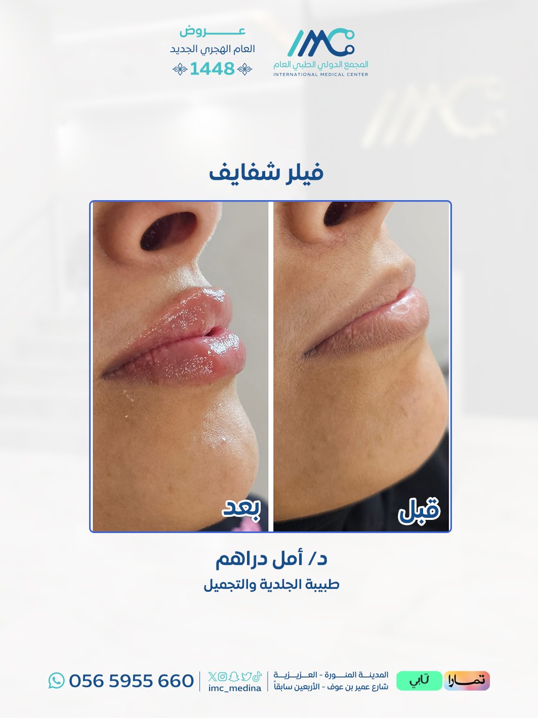 فيلر1